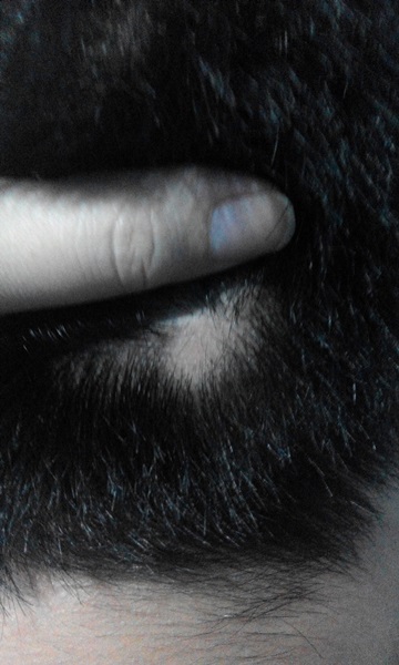 Mengatasi kebotakan alopecia dengan terapi salep daktarin oral gel