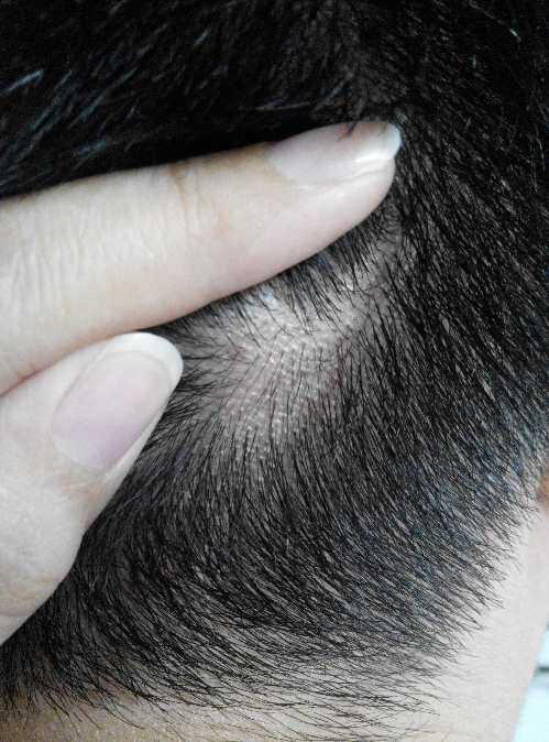 Hasil terapi salep daktarin oral gel untuk kebotakan alopecia